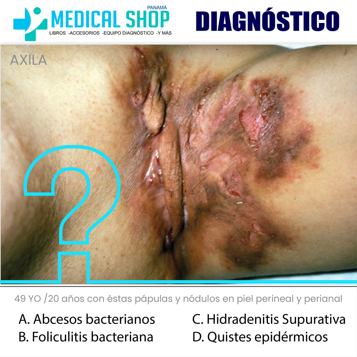Quiz: Hidradenitis Supurativa