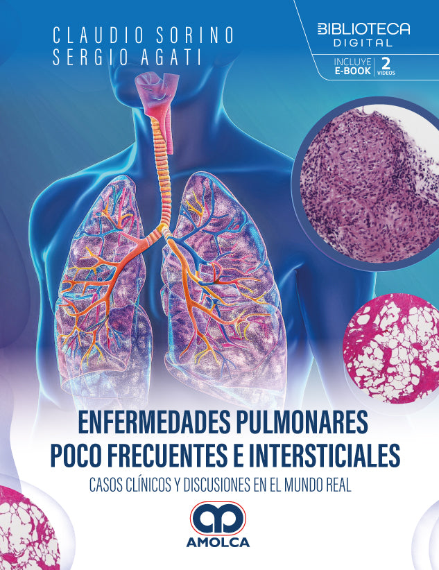 Enfermedades pulmonares poco frecuentes e intersticiales.