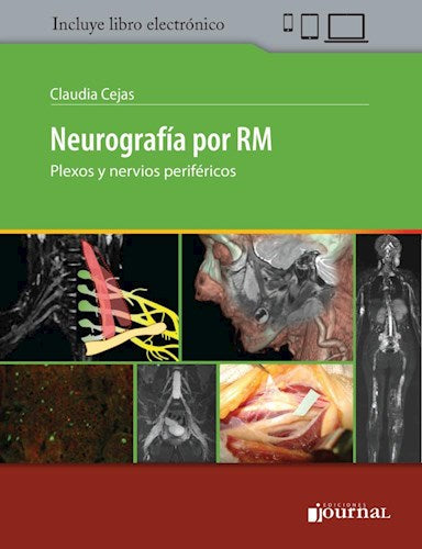 Neurografía por RM