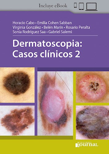 Dermatoscopia: Casos clínicos 2