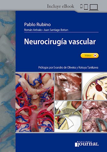 Neurocirugía vascular